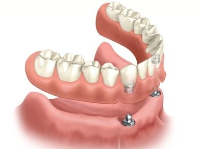 overdenture