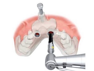 cirurgia-guiada-2