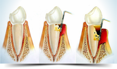 cirurgia-periodontal