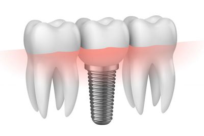 implantes-dentarios