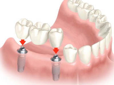 protese-sobre-implante-multipla-1