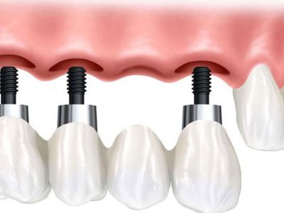 protese-sobre-implante-multipla-2
